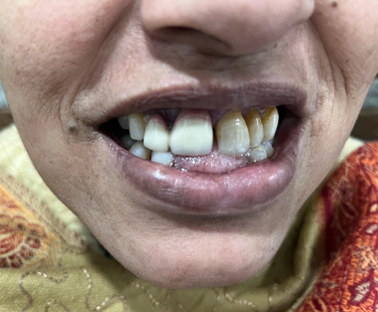 Dental Implant Before Case 2 - Central Polyclinic